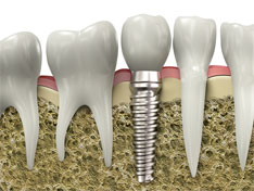 Implantat