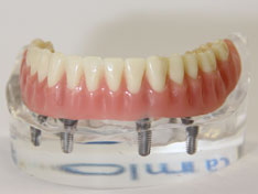 Implantat