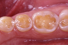 Inlay (© Edelhoff-Brix)