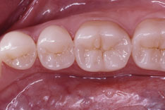 Inlay (© Edelhoff-Brix)