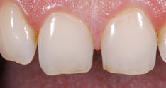 Veneer