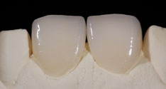 Veneer