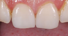 Veneer